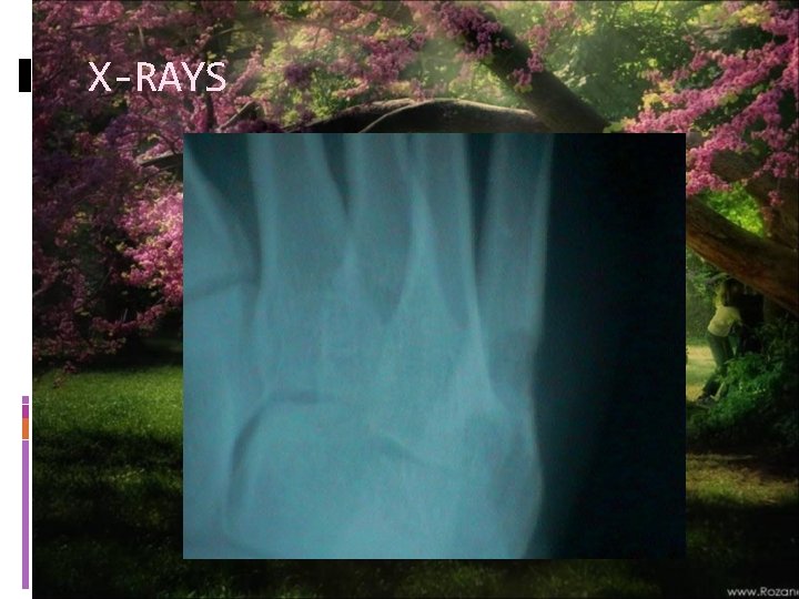 X-RAYS 