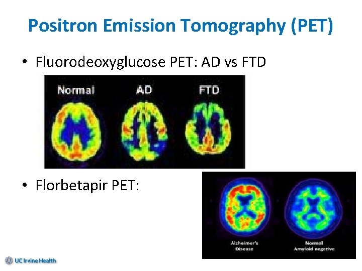 Positron Emission Tomography (PET) • Fluorodeoxyglucose PET: AD vs FTD • Florbetapir PET: 
