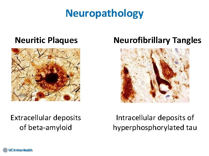 Neuropathology Neuritic Plaques Extracellular deposits of beta-amyloid Neurofibrillary Tangles Intracellular deposits of hyperphosphorylated tau