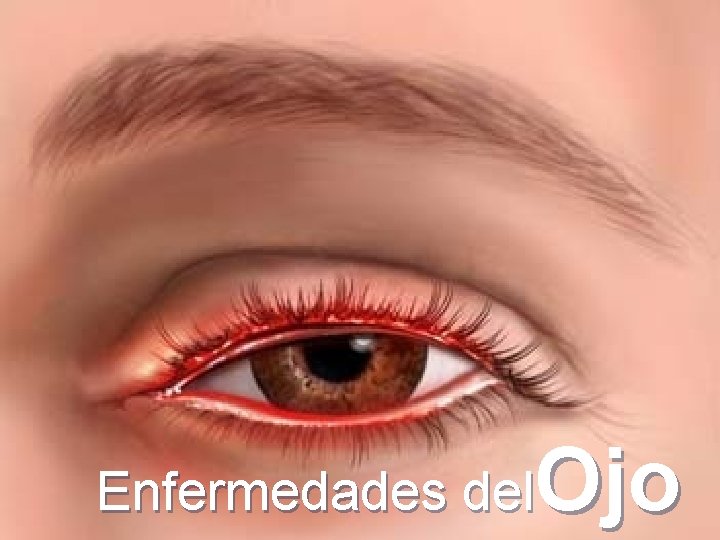 Ojo Enfermedades del 