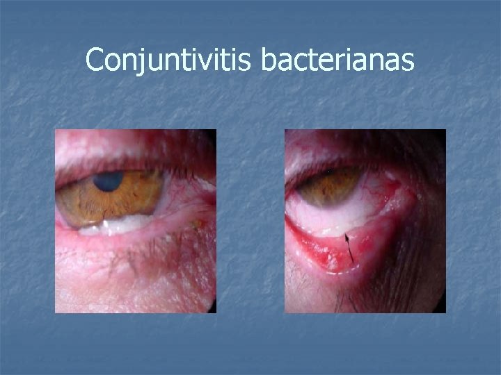 Conjuntivitis bacterianas 