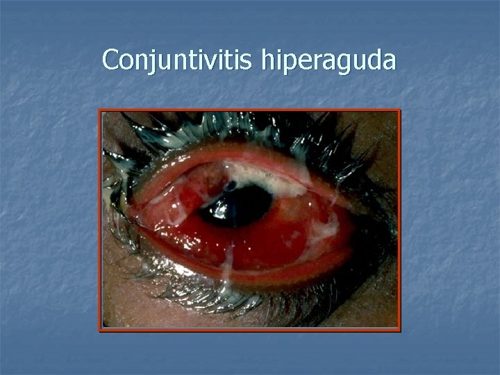 Conjuntivitis hiperaguda 