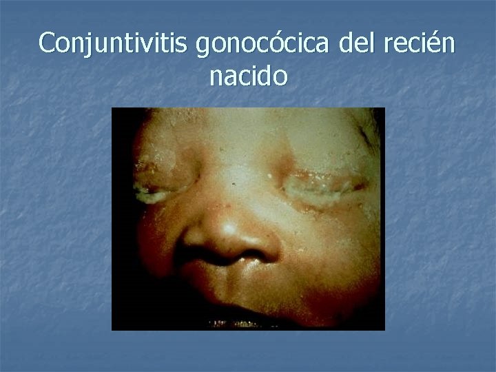 Conjuntivitis gonocócica del recién nacido 