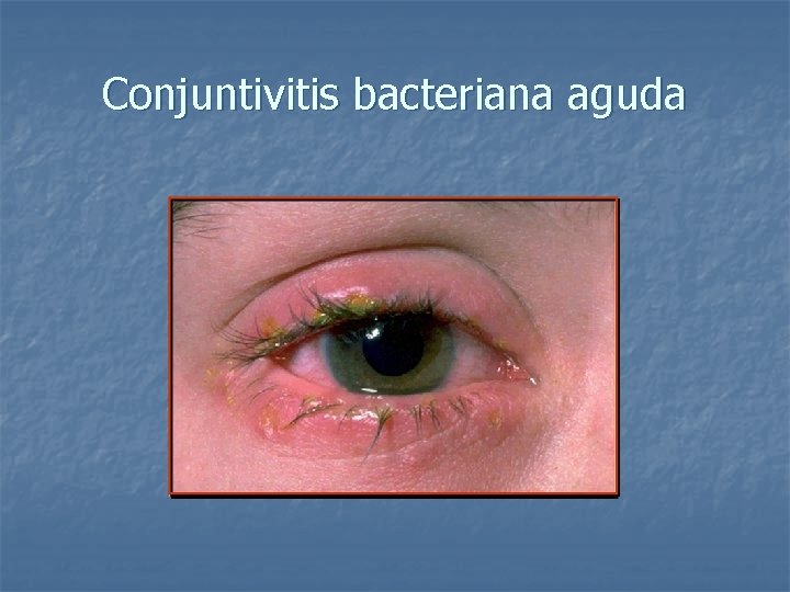 Conjuntivitis bacteriana aguda 