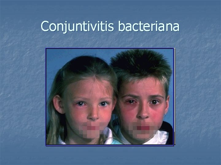 Conjuntivitis bacteriana 