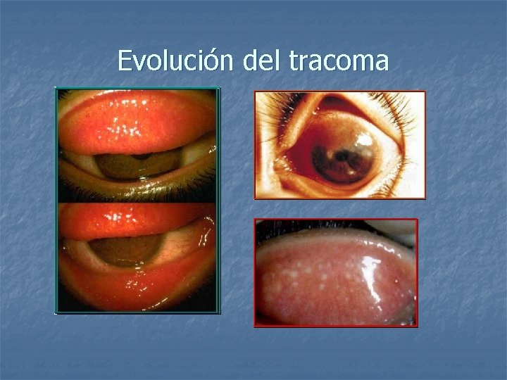 Evolución del tracoma 