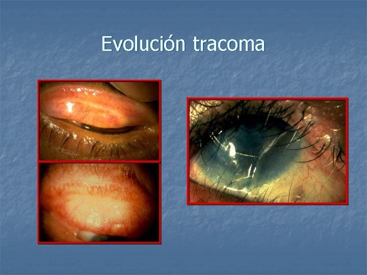 Evolución tracoma 