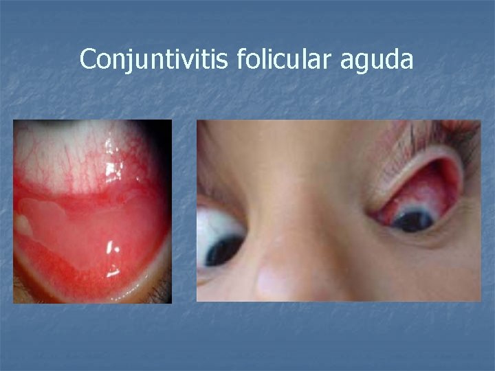 Conjuntivitis folicular aguda 