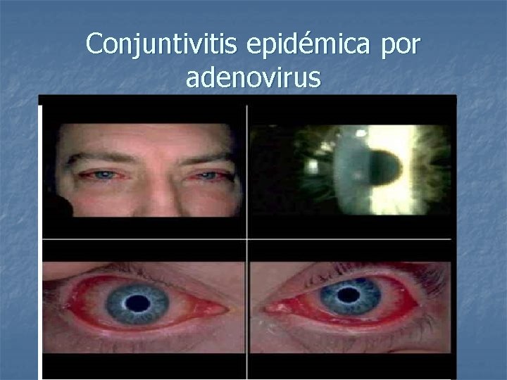 Conjuntivitis epidémica por adenovirus 