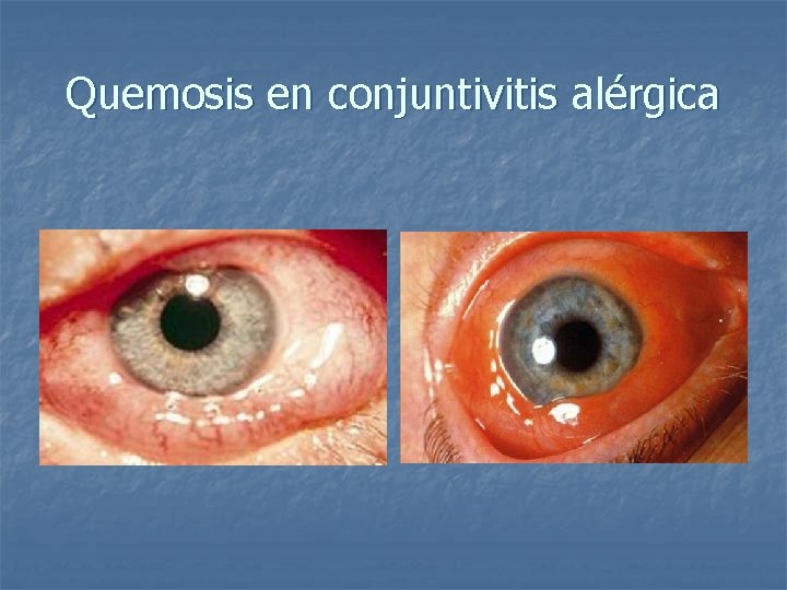 Quemosis en conjuntivitis alérgica 