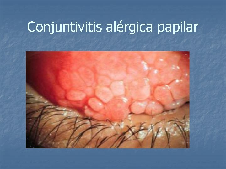 Conjuntivitis alérgica papilar 