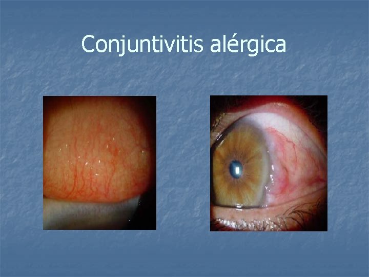 Conjuntivitis alérgica 