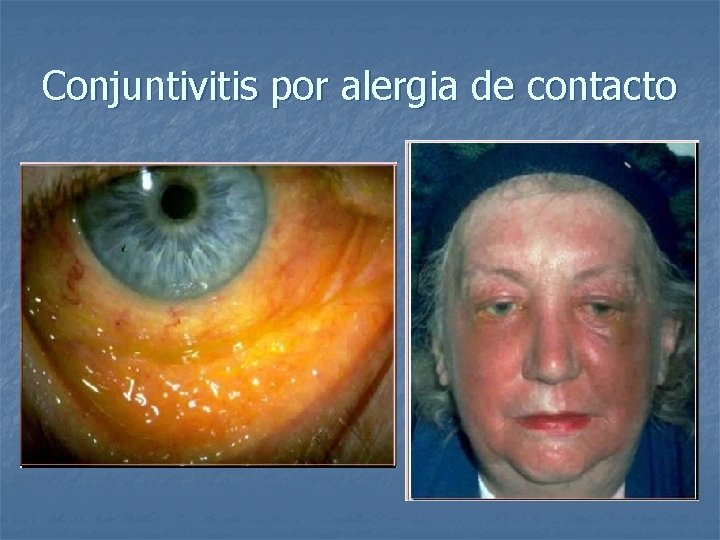 Conjuntivitis por alergia de contacto 