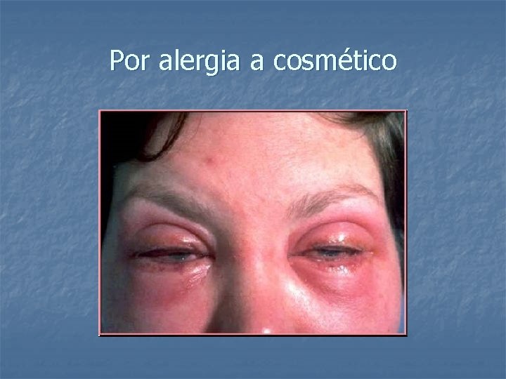 Por alergia a cosmético 