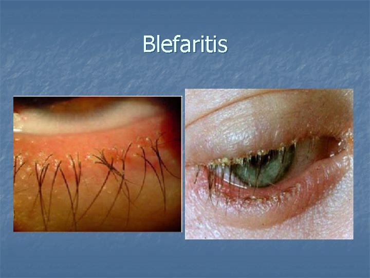Blefaritis 