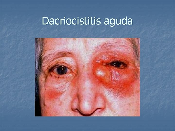 Dacriocistitis aguda 