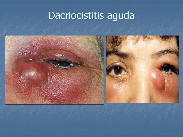 Dacriocistitis aguda 