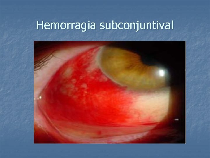 Hemorragia subconjuntival 