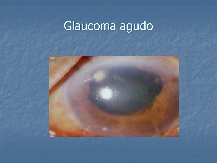 Glaucoma agudo 