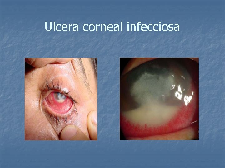 Ulcera corneal infecciosa 