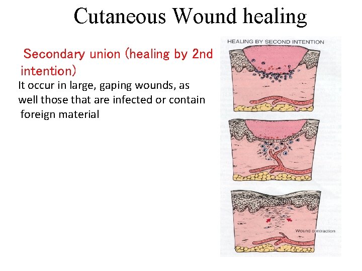 Cutaneous Wound healing Secondary union (healing by 2 nd intention) It occur in large,