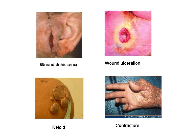 Wound dehiscence Keloid Wound ulceration Contracture 