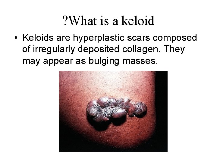? What is a keloid • Keloids are hyperplastic scars composed of irregularly deposited