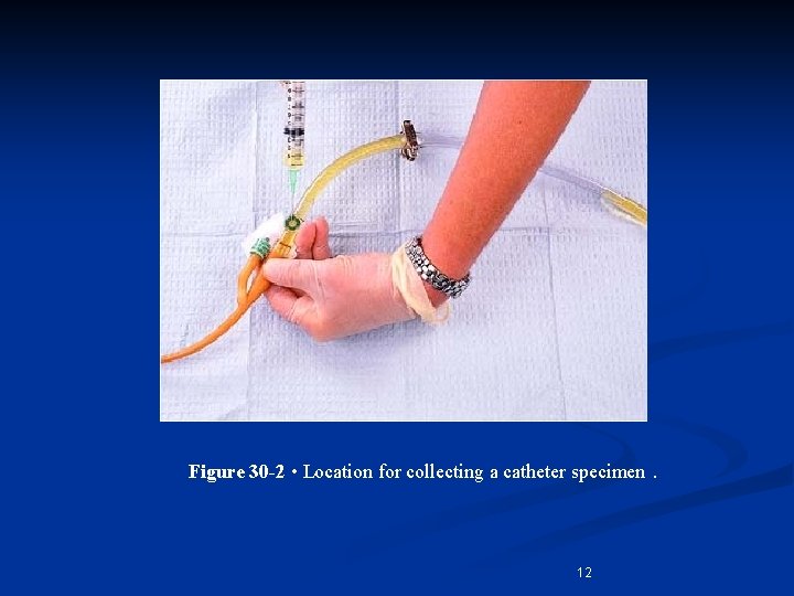 Figure 30 -2 • Location for collecting a catheter specimen. 12 