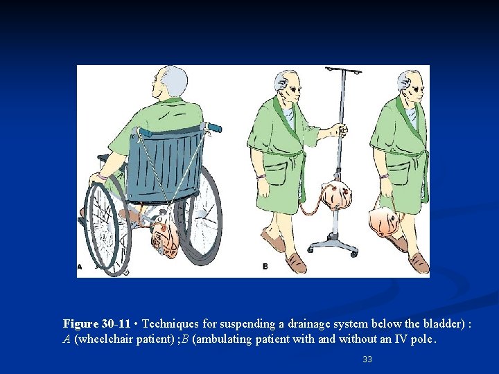 Figure 30 -11 • Techniques for suspending a drainage system below the bladder) :