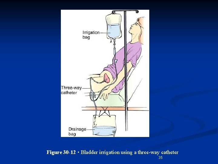 Figure 30 -12 • Bladder irrigation using a three-way catheter 35 