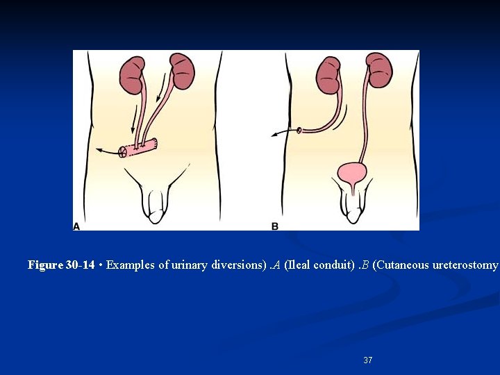 Figure 30 -14 • Examples of urinary diversions). A (Ileal conduit). B (Cutaneous ureterostomy