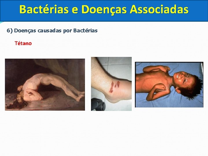 Bactérias e Doenças Associadas 6) Doenças causadas por Bactérias Tétano 