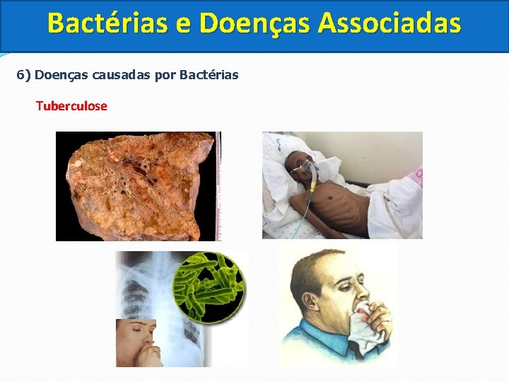 Bactérias e Doenças Associadas 6) Doenças causadas por Bactérias Tuberculose 