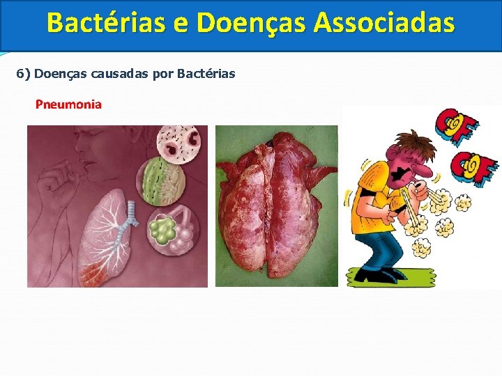 Bactérias e Doenças Associadas 6) Doenças causadas por Bactérias Pneumonia 