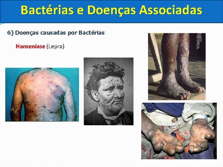 Bactérias e Doenças Associadas 6) Doenças causadas por Bactérias Hanseníase (Lepra) 