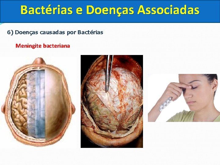 Bactérias e Doenças Associadas 6) Doenças causadas por Bactérias Meningite bacteriana 