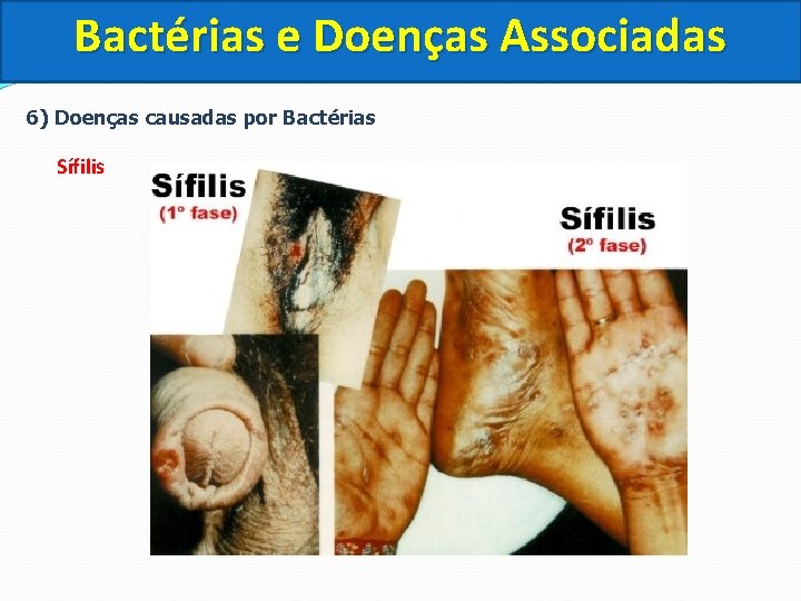 Bactérias e Doenças Associadas 6) Doenças causadas por Bactérias Sífilis 