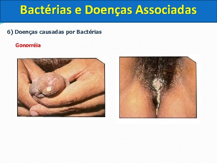 Bactérias e Doenças Associadas 6) Doenças causadas por Bactérias Gonorréia 