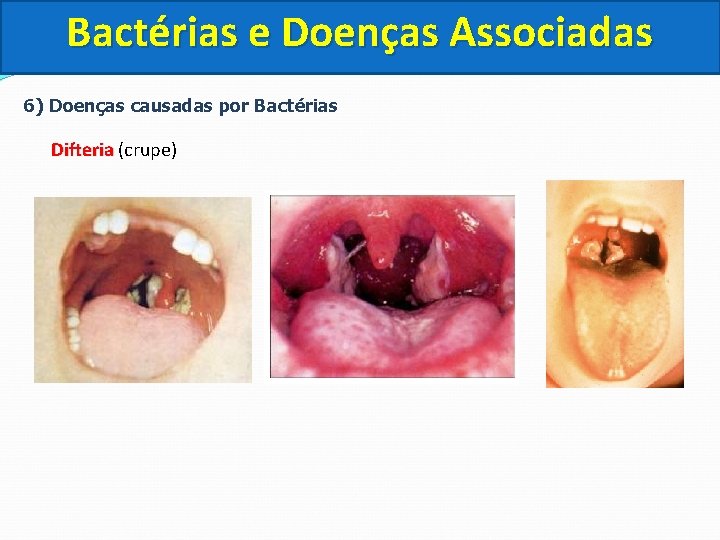 Bactérias e Doenças Associadas 6) Doenças causadas por Bactérias Difteria (crupe) Difteria 