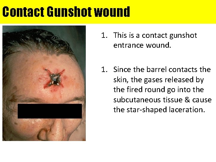 Contact Gunshot wound 1. This is a contact gunshot entrance wound. 1. Since the