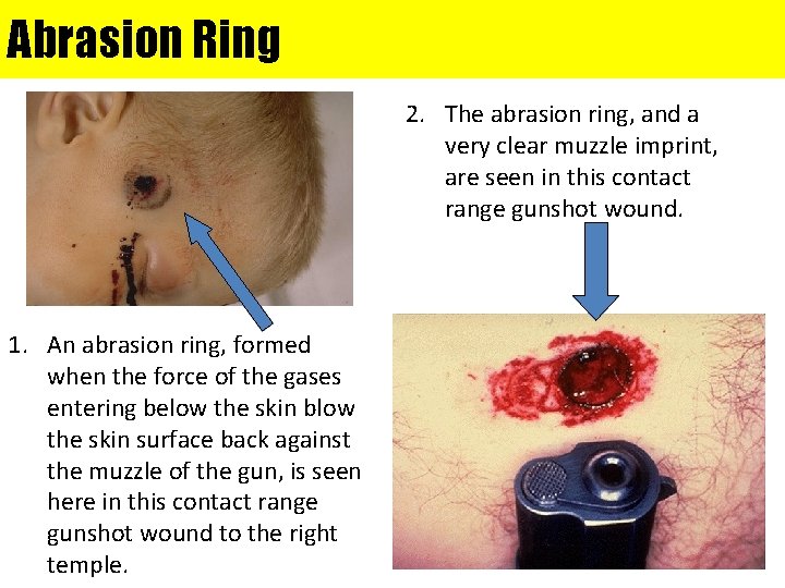 Abrasion Ring 2. The abrasion ring, and a very clear muzzle imprint, are seen