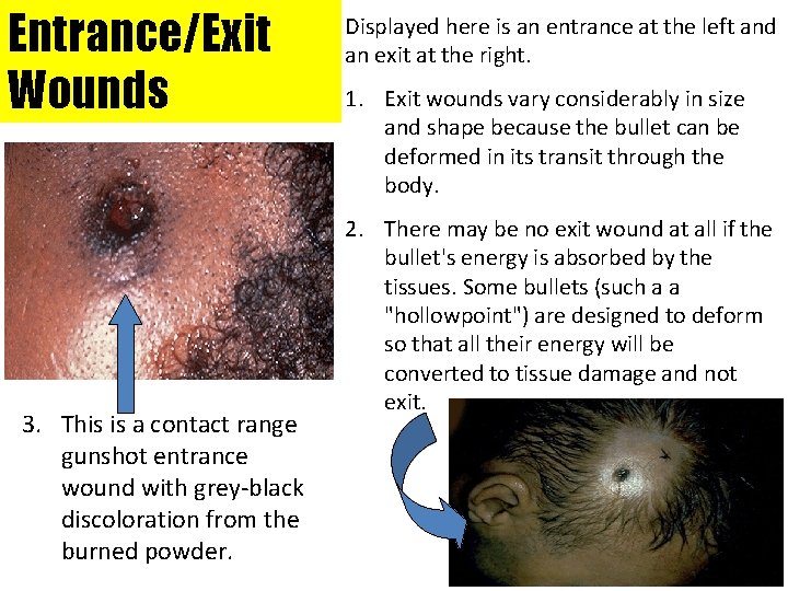 Entrance/Exit Wounds 3. This is a contact range gunshot entrance wound with grey-black discoloration