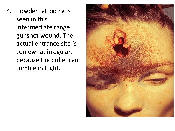 4. Powder tattooing is seen in this intermediate range gunshot wound. The actual entrance