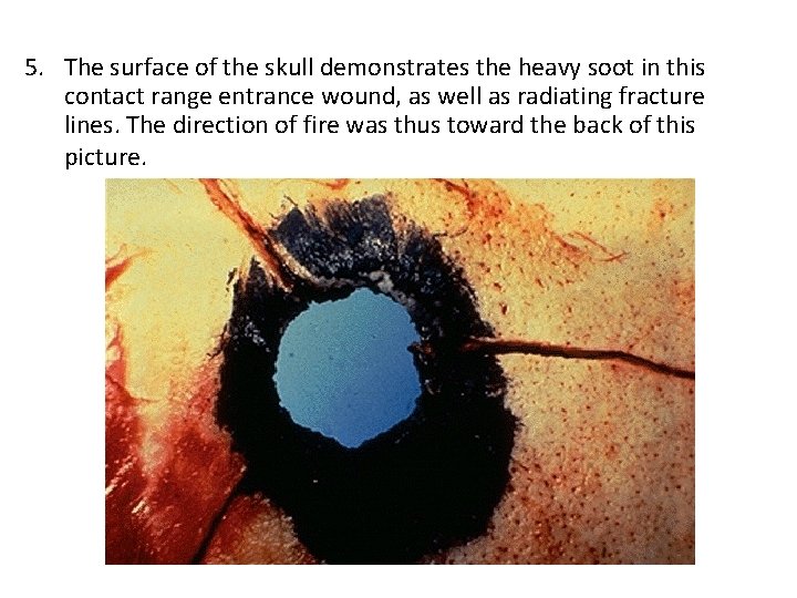 5. The surface of the skull demonstrates the heavy soot in this contact range