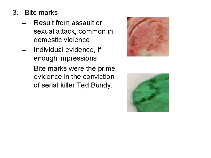 3. Bite marks – Result from assault or sexual attack, common in domestic violence