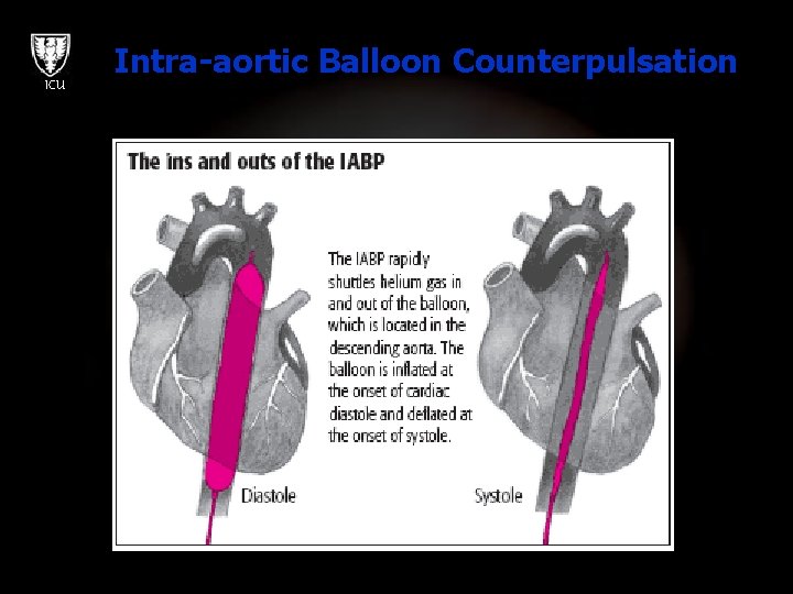 ICU Intra-aortic Balloon Counterpulsation 