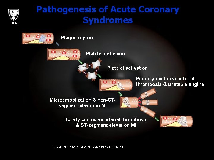 ICU Pathogenesis of Acute Coronary Syndromes Plaque rupture Platelet adhesion Platelet activation Partially occlusive