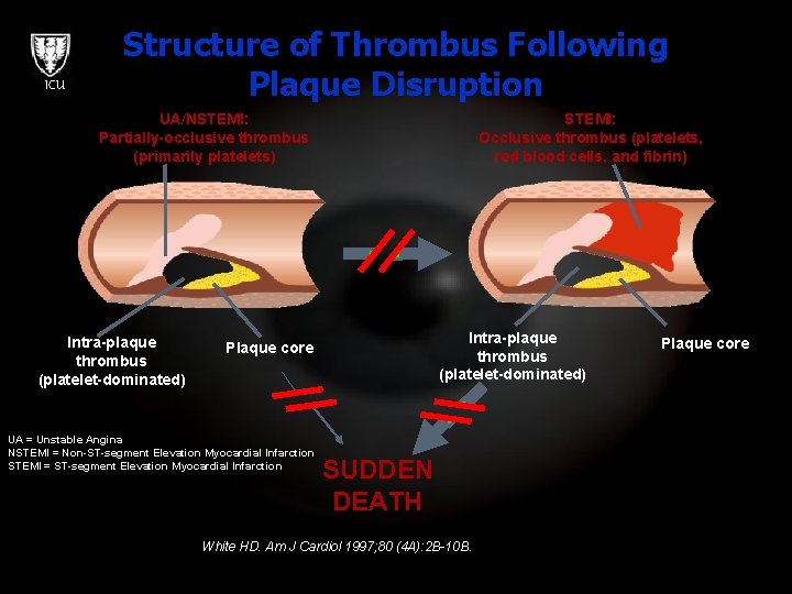 ICU Structure of Thrombus Following Plaque Disruption UA/NSTEMI: Partially-occlusive thrombus (primarily platelets) Intra-plaque thrombus