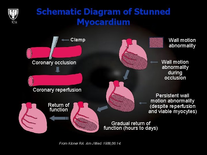 ICU Schematic Diagram of Stunned Myocardium Clamp Wall motion abnormality during occlusion Coronary reperfusion