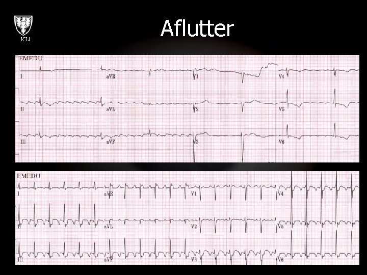 ICU Aflutter 